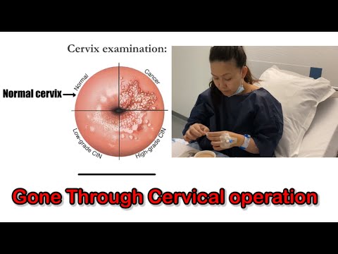 Gone through Cervical Operation/CIN3 High grade/Next one Cervical Cancer