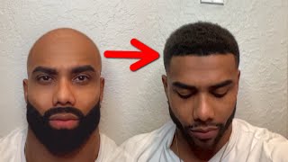 How To Keep Your Hairline Forever (Anti Balding Routine)