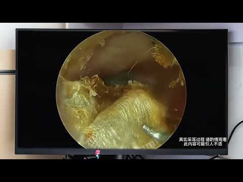 Deep Ear Cleaning Procedure — Insanely Satisfying Ear Wax Removal