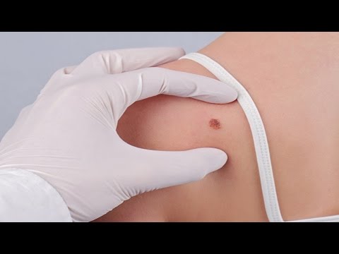 Hydrocortisone ใบหน้าครีมกลาก โรคสะเก็ดเงิน celandine ครีม