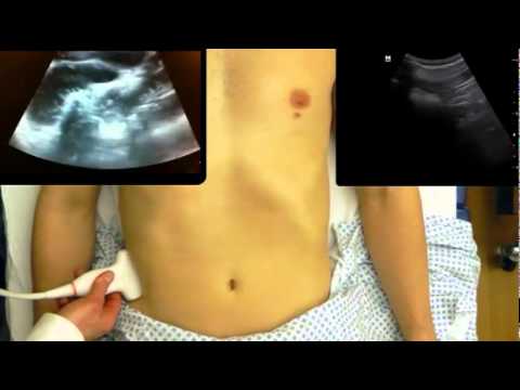 Small Bowel Obstruction Ultrasound from One Minute Ultrasound