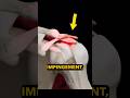 Shoulder Impingement 2 Things You NEED To Know