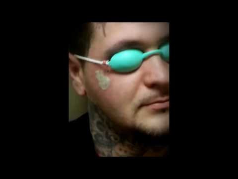 Rapper Gets Crazy Face Tattoos Removed! NO Numbing Cream