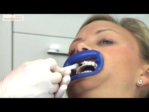 Bleaching / Zahnaufhellung - Zahnarzt Dr. Dettler Oberursel - Smile Professionals