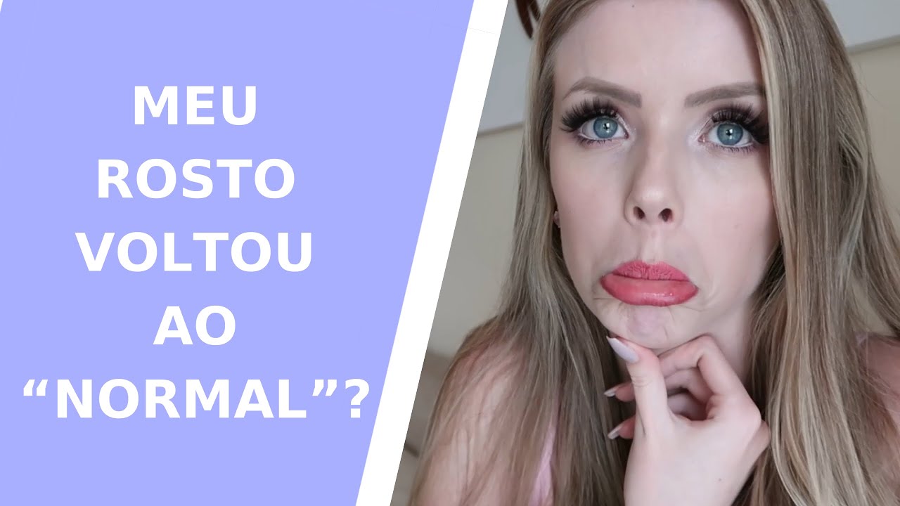 HARMONIZAÇÃO FACIAL após 1 ano de procedimento