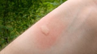 What are the Bug Bites That Cause Swelling And How to Treat Them