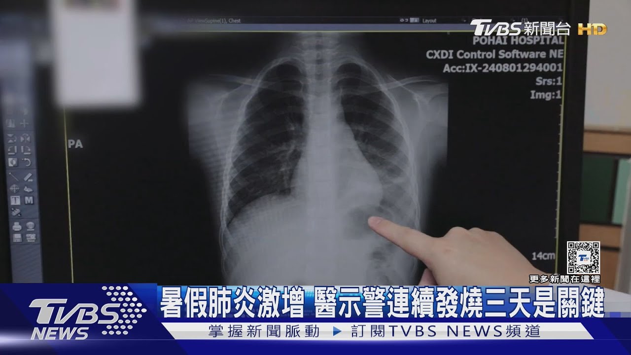 暑假肺炎激增 醫示警連續發燒三天是關鍵