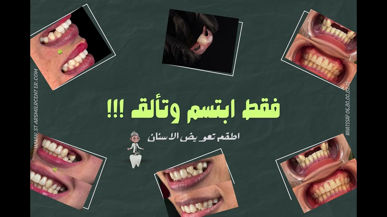 أطقم تعويض الأسنان thumbnail
