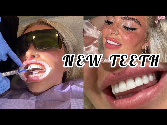 Braces, Whitening & Composite Veneers