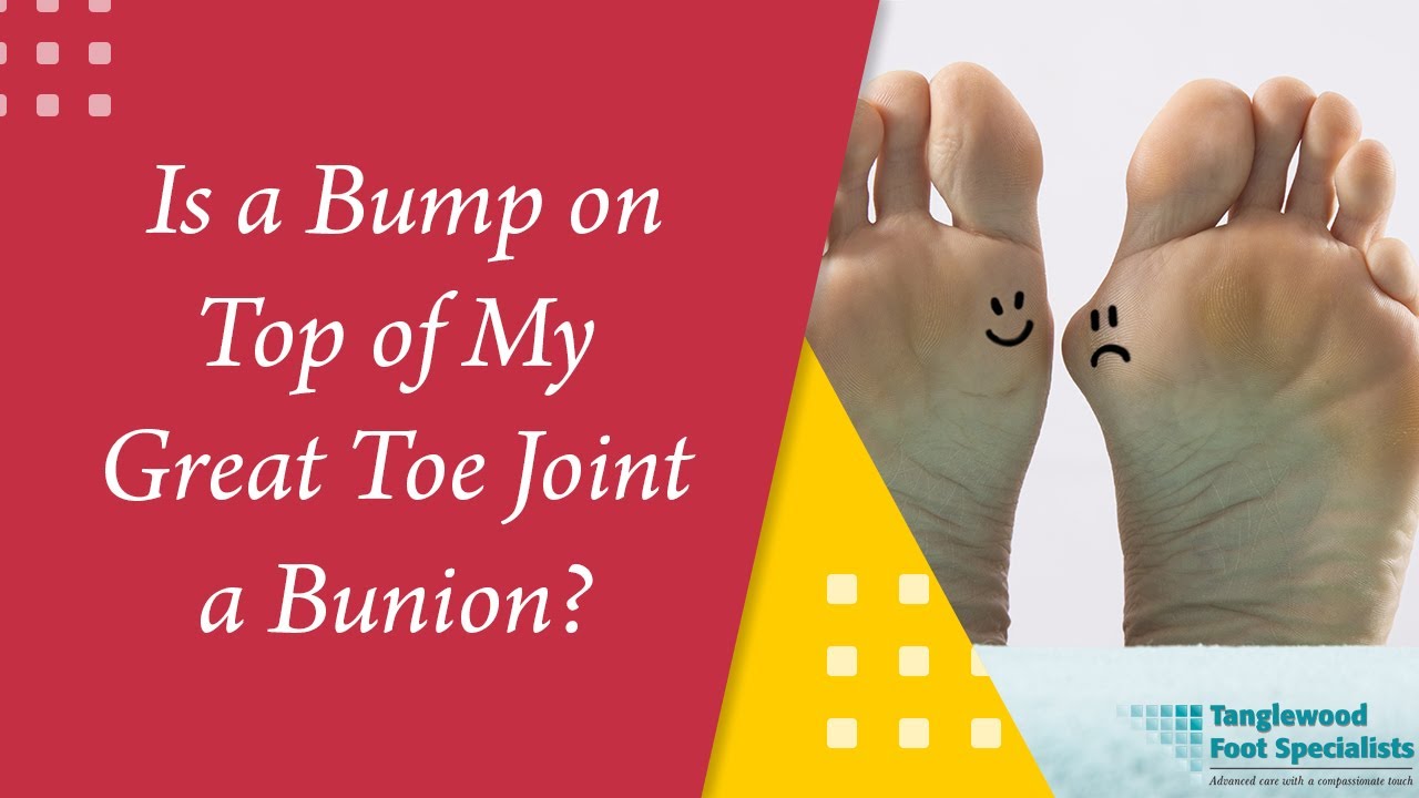 Is a Bump on Top of My Great Toe Joint a Bunion?