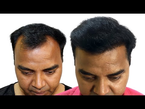 Hairline & Crown Hair Transplant Results | Best Hair...