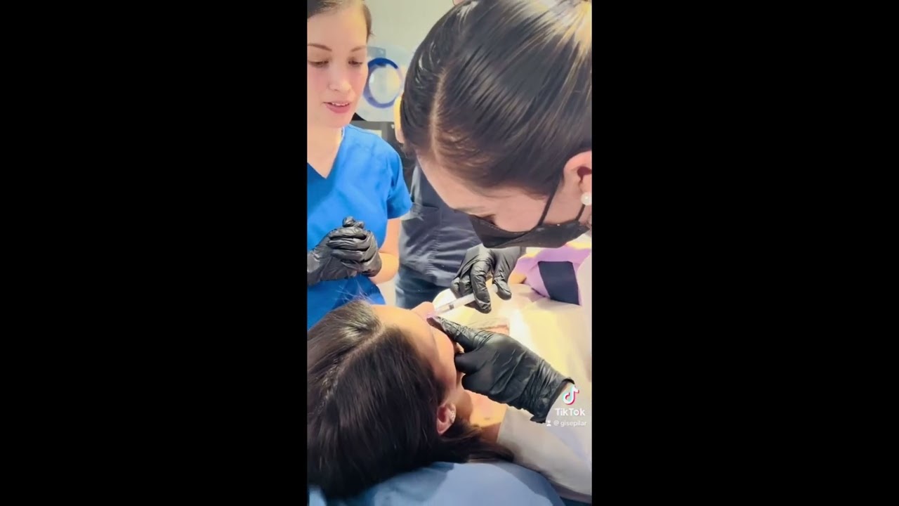 NCTF Ácido Hialurónico como mesoterapia para arrugas finas de ojeras