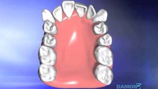 Tratamiento Ortodoncia revolucionario DAMON - Clínica de Odontología Natural Dra. León