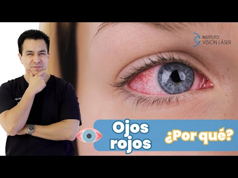Ojos rojos ¿por qué?