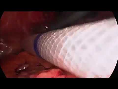 Operacja laparoskopowa przepukliny okołostomijnej zmodyfikowaną metodą Sugarbakera