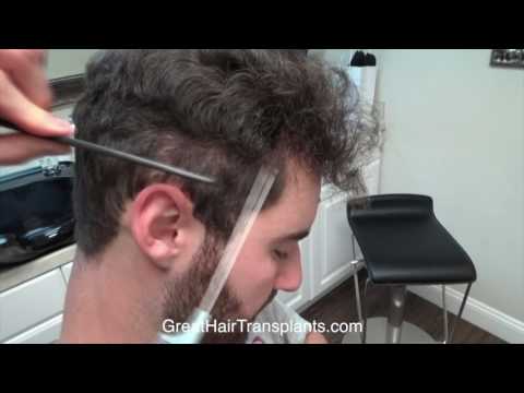 

Dr. Brett Bolton FUE Correction Patient Casey Full Video

