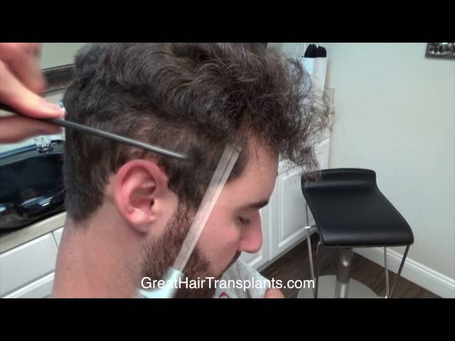 

Dr. Brett Bolton FUE Correction Patient Casey Full Video


