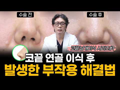세계가 주목한 코끝성형 '코끝 날개이식', 도대체 무엇인가요?