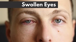 Swollen eyes - EXPLAINED! | Dr. D