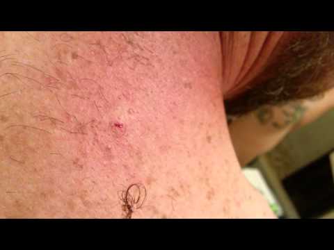 Ingrown Hair Removal Gross Videos - Armpit Face Stomach