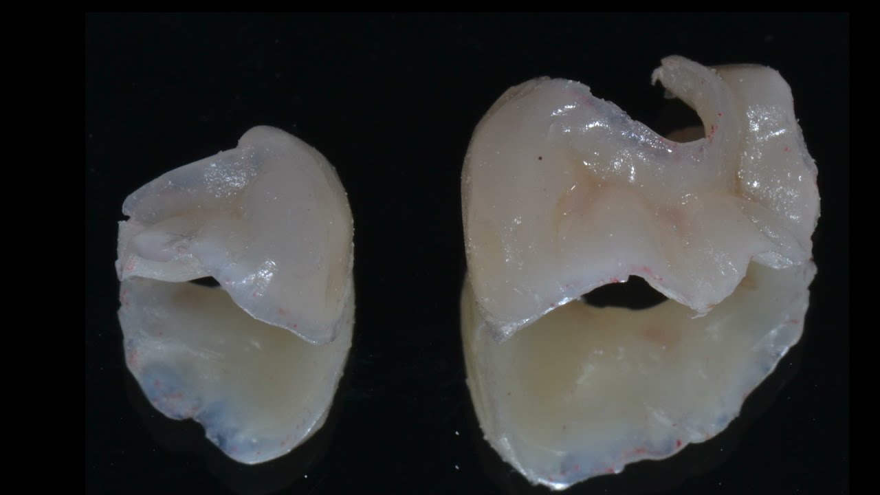 Preparo para inlay e onlay