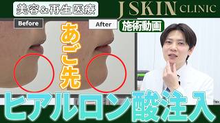 あご先のヒアルロン酸治療の様子【施術動画】