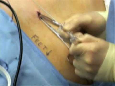 Right Laparoscopic Radical Nephrectomy - Part 1