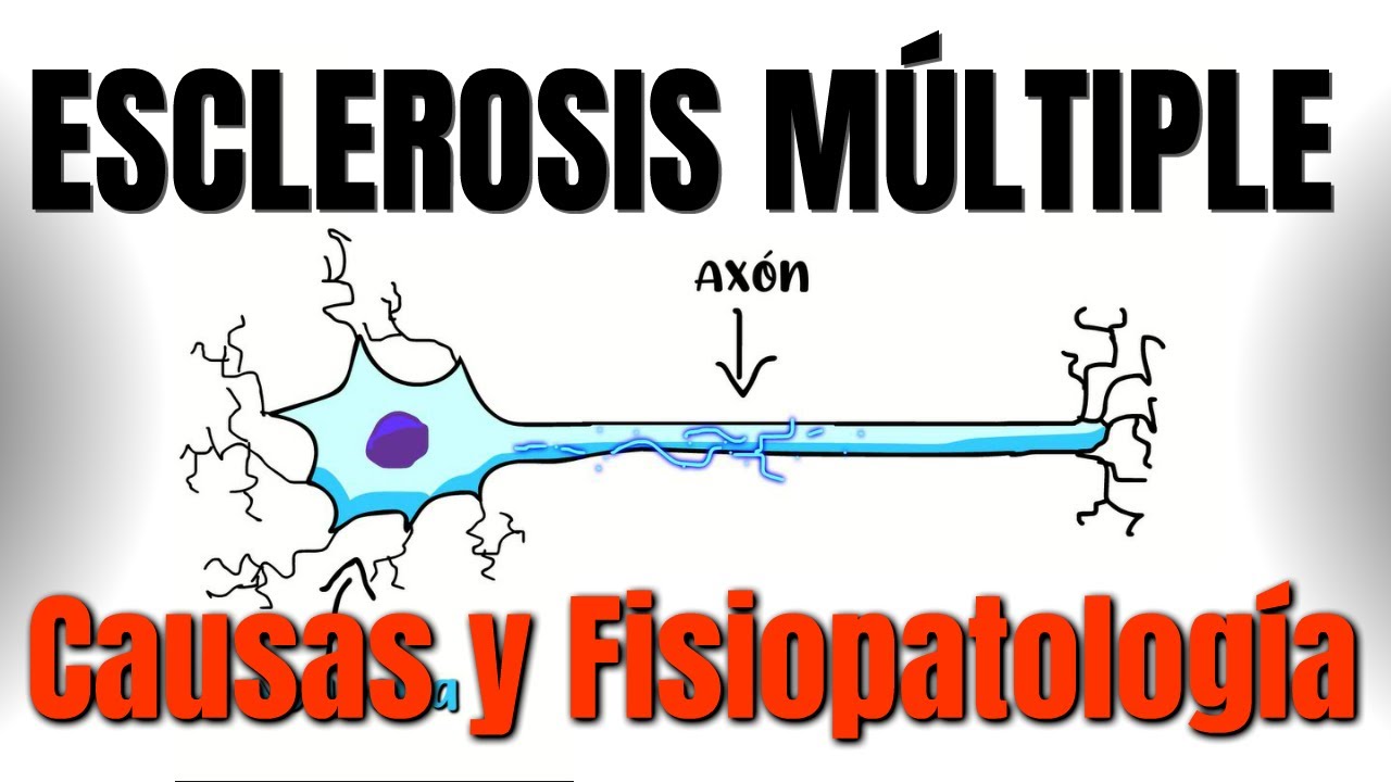 Esclerosis múltiple CAUSAS y FISIOPATOLOGÍA  || P1