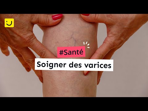 Soigner des varices