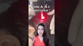👩🏻ผมและคิ้วหนาขึ้นจริงเพราะเลเซอร์ใหม่ล่าสุดตัวนี้ !! ##erkerkbeauty #wwwerkerkcom #redtouchpro