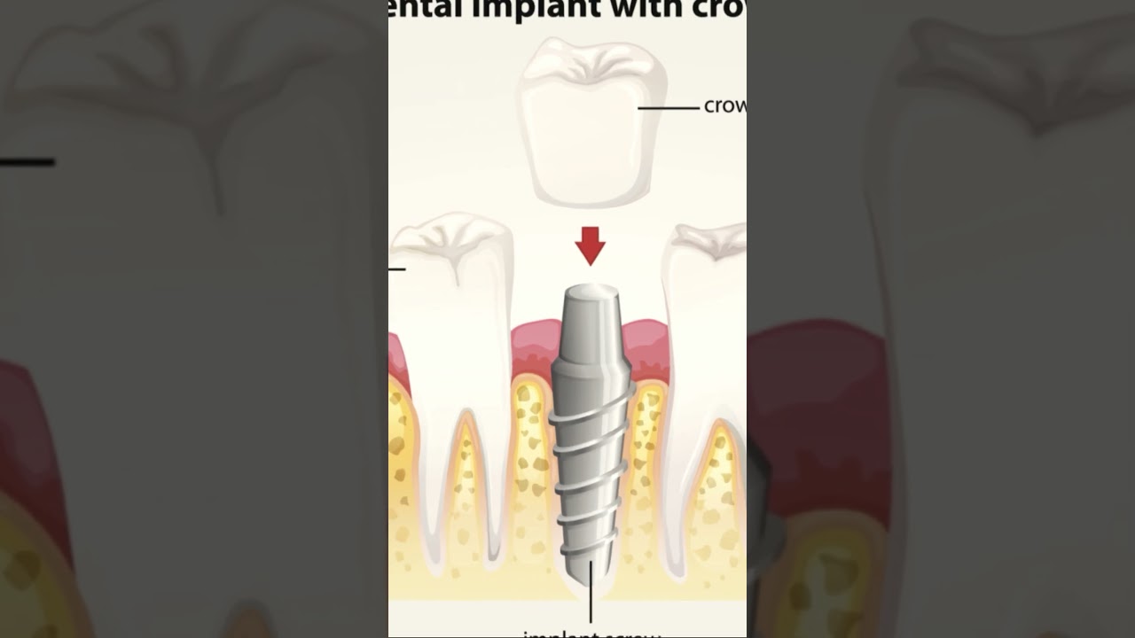 Dental implants can help you improve your smile, confidence, and overall quality of life.