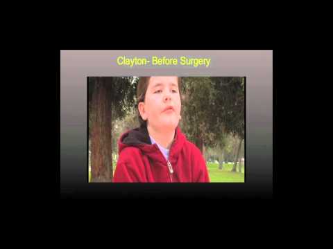 What can you do with half a brain? Dr. Gary Mathern at TEDxConejo