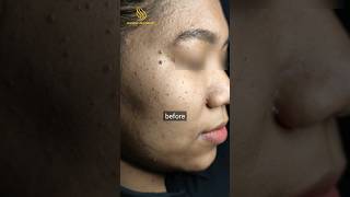 Download lagu Skin Tags 1 tahun Setelah Laser CO2, Tumbuh Lagi? #Skintags #LaserCO2 #ShineryAesthetic mp3