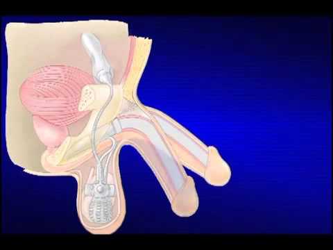Die Symptome der Prostatitis Schmerz Veränderungen in der Prostata Stromatumoren