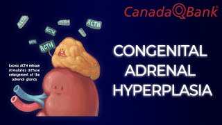 Download lagu Congenital Adrenal Hyperplasia mp3 Download lagu Congenital Adrenal Hyperplasia mp3