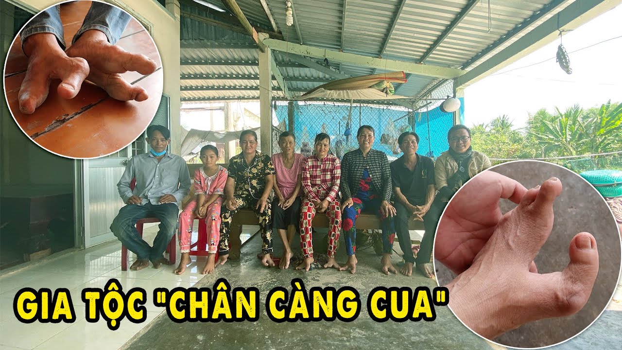 Nghiệp duyên khiến gia đình 3 đời có “Chân Càng Cua” luôn Lạc Quan
