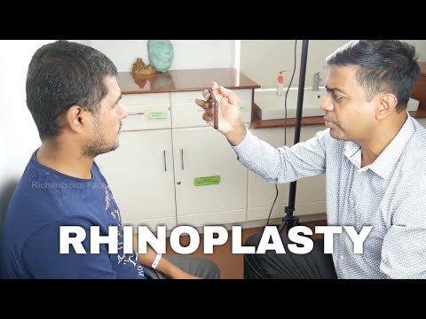 Rhinoplasty Surgery Experience In India