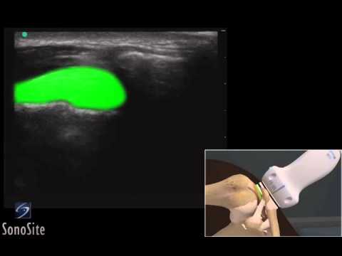 comment soigner entorse acromio claviculaire