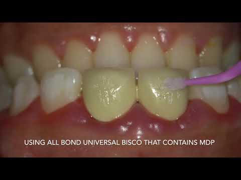orthodontic brackets bonding to porcelain crowns by dr Amr Asker