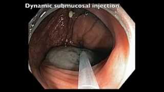 Colonoscopy Channel - EMR of Flat Lesion in Transverse Colon - Serrated Polyp