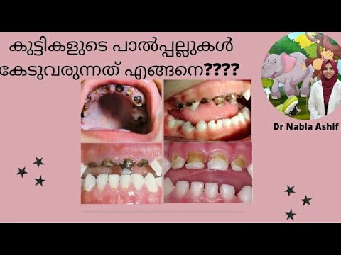 How to keep children's teeth healthy / How to protect baby teeth