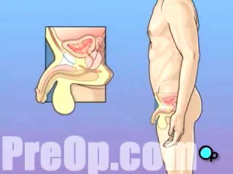 PreOp® Patient Education Cystoscopy Male 2