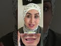 Crooked smile after Botox