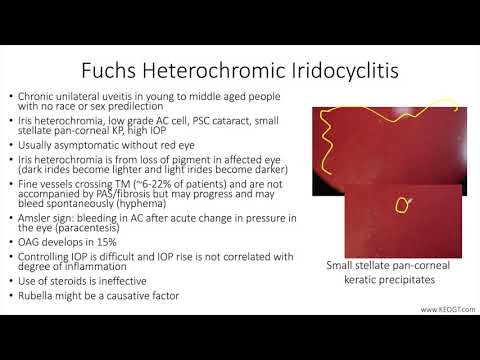 Lecture: Fuchs’ Heterochromic Iridocyclitis (1 Slide in 5 Minutes)