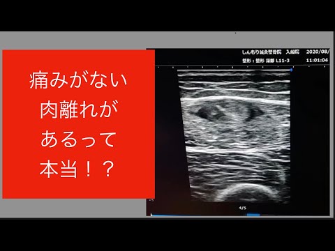 痛みがない肉離れがあるって本当？？