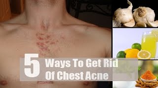 5 Home Remedies to Get Rid of Chest Acne | By Top 5.