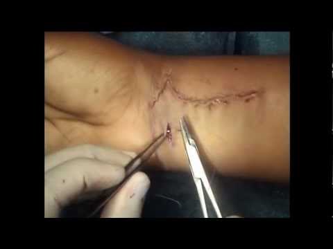 Distal Radius Fracture Repair with Volar Plate