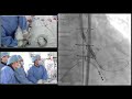 AP VALVES SH 2019 Live Case Lecture 2 TAVR 3