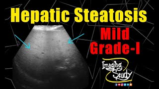 Mild Hepatic Steatosis || Grade-I Fatty Liver || Ultrasound || Case 226