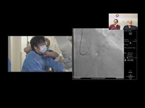 Coronary Orbital Atherectomy in OCT Live in Kamakura